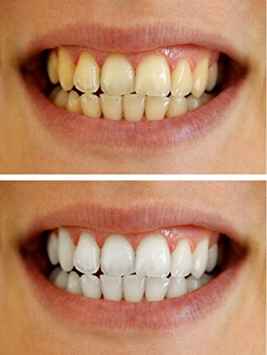 Pictured Strongest Whitening: Bleach Pro Whitening Teeth Whitening Gel 44% Syringes