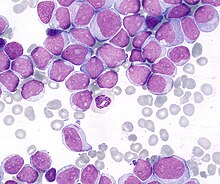 Acute Myeloid Leukemia (AML)