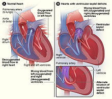Complex Congenital Heart Surgery