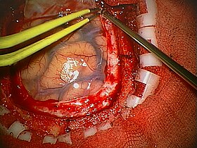 Craniotomy for tumor removal