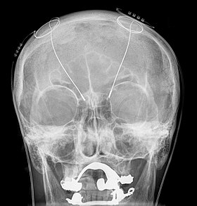 Deep brain stimulation (DBS) surgery