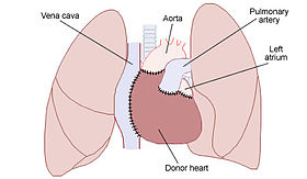 Heart Transplant