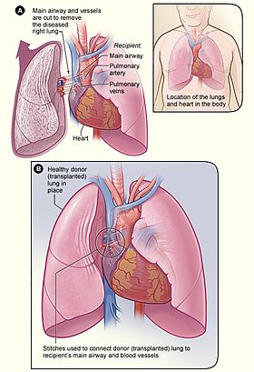 Lung Transplant