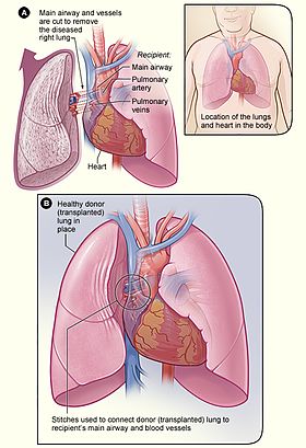 Lung