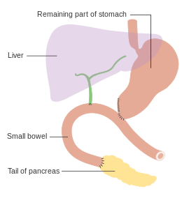 Pancreaticoduodenectomy (Whipple Procedure)