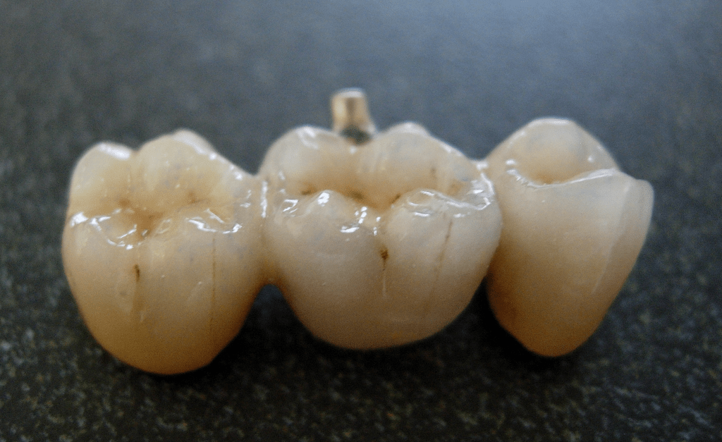 Teeth with a dental implant